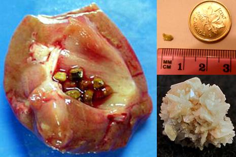 C&aacute;lculo renal