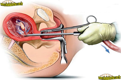 Aborto tecnica cirurgica