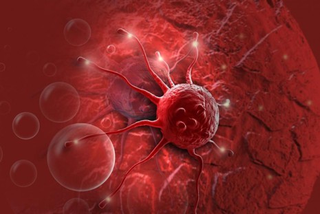 Câncer de colo de útero pode ser uma doença silenciosa . Conheça os sintomas e prevenção.