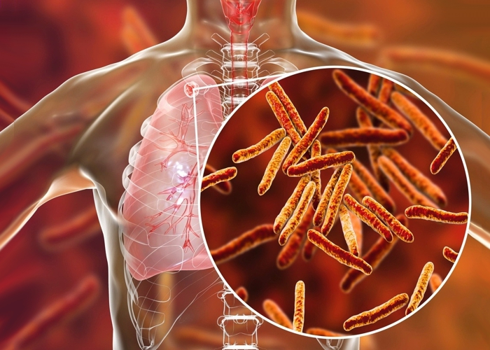 Tuberculose traz “custos catastróficos” para metade das famílias brasileiras afetadas